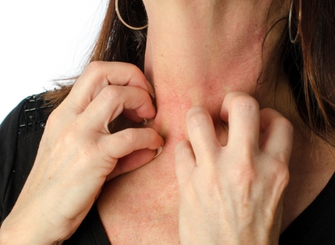 Eczéma de contact : des chercheurs expliquent la récidive et la chronicité