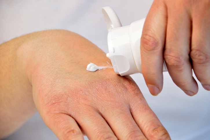 Eczéma : un nouveau moyen naturel pour le traiter 