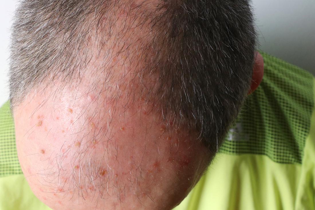 Carcinomes cutanés : rôle préventif des immunothérapies sur le champ de cancérisation ?