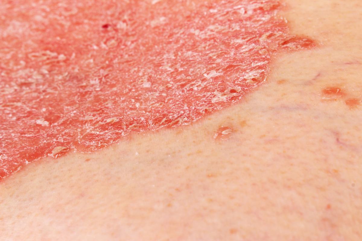 Rhumatisme psoriasique : un inhibiteur de TYK2 pourrait changer la donne 
