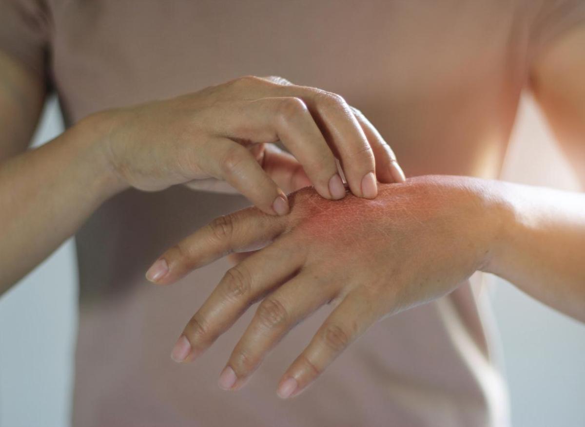 Psoriasis : un lien avec les aliments ultra-transformés ?