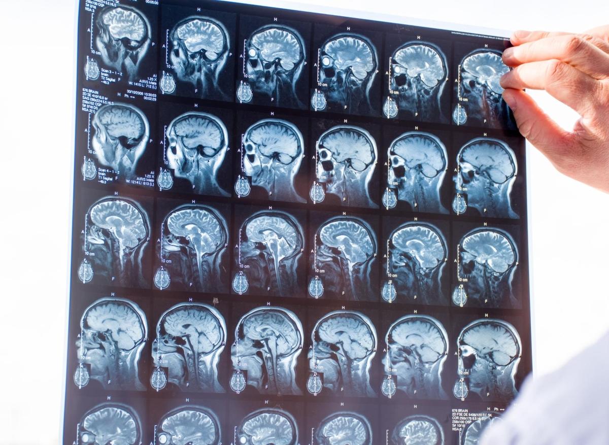Épilepsie : un nouveau traitement de l'état de mal épileptique