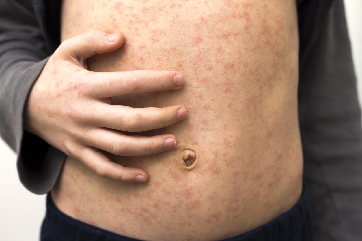 Rougeole : 828 cas ont été déclarés en France depuis le début de l’année