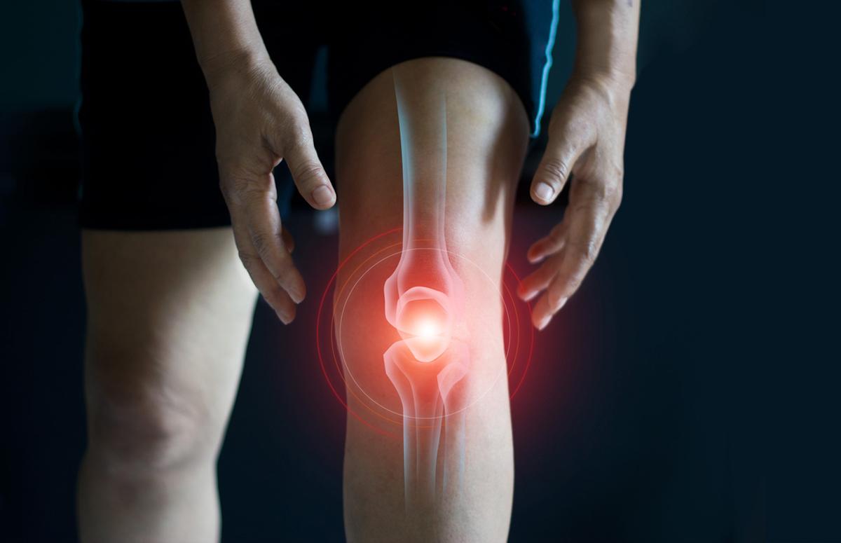 Gonarthrose avec synovite et épanchement : pas d’efficacité du méthotrexate