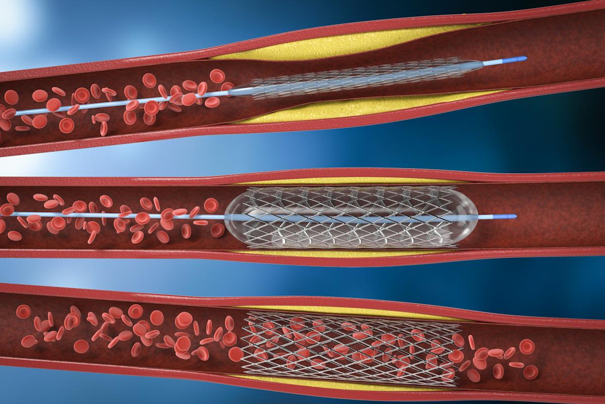 Insuffisance coronaire : la monothérapie inhibiteur de P2Y12 fait mieux que l’aspirine à long terme en post-stent