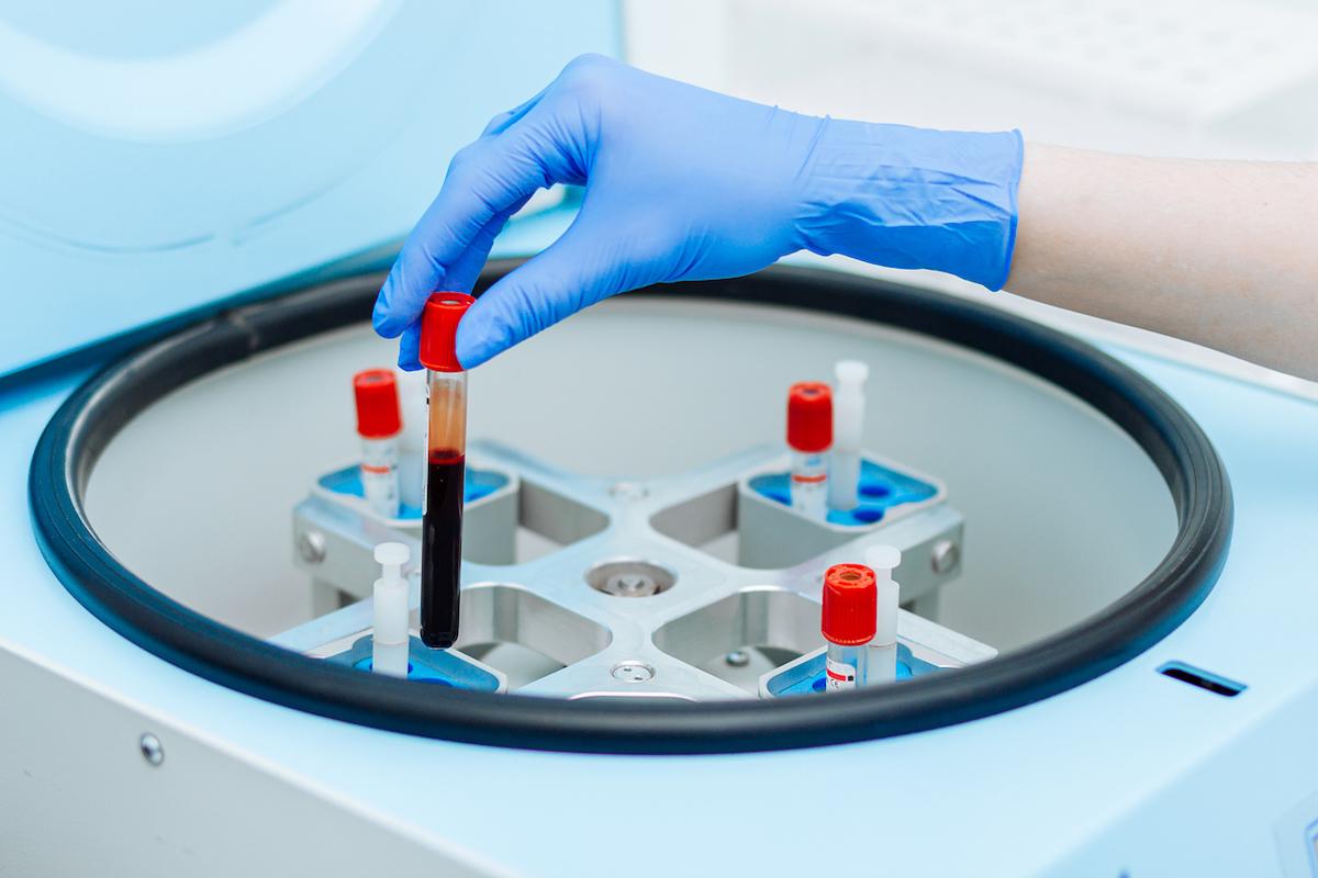 CAR-T cells et risque de second cancer : mieux sélectionner les malades
