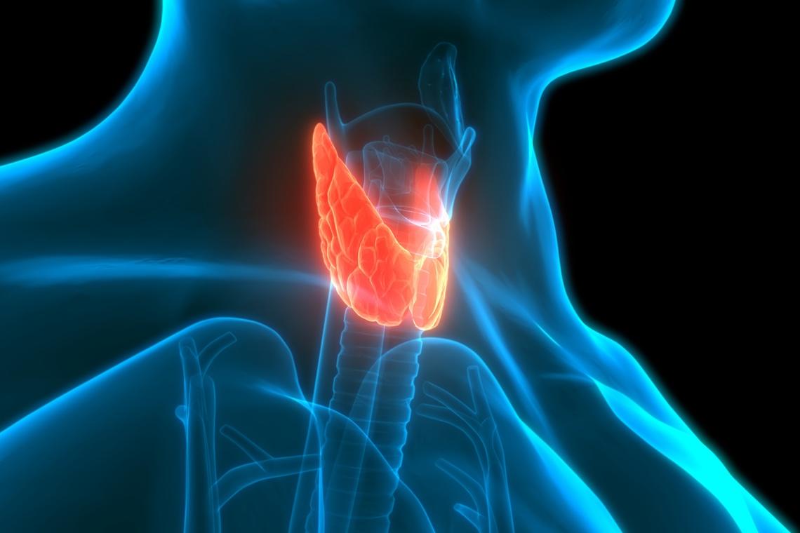 Mélanome : risque accru après cancer papillaire de la thyroïde traité à l'iode radioactif