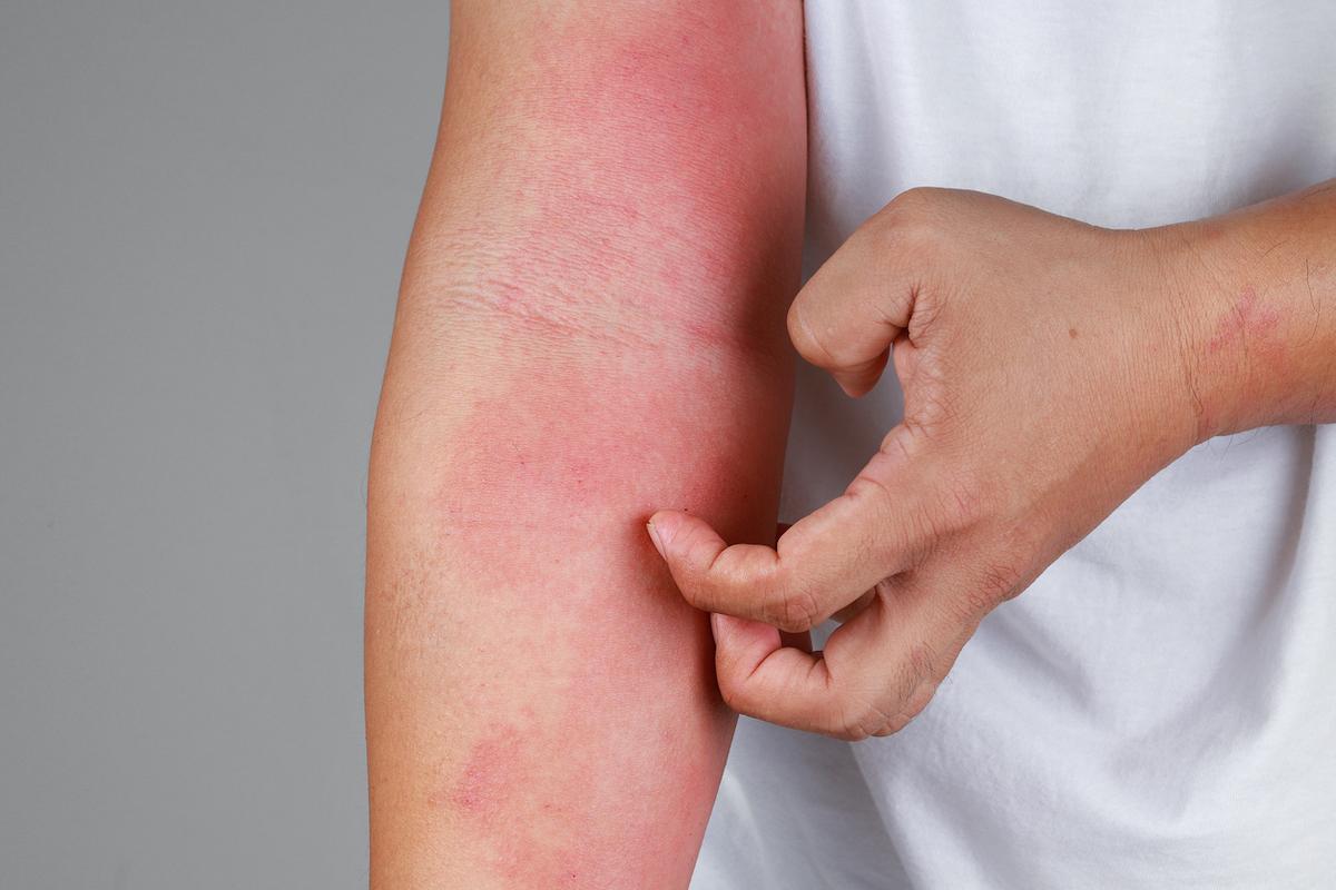 Dermatite atopique : attention aux utilisations abusives de la corticothérapie orale