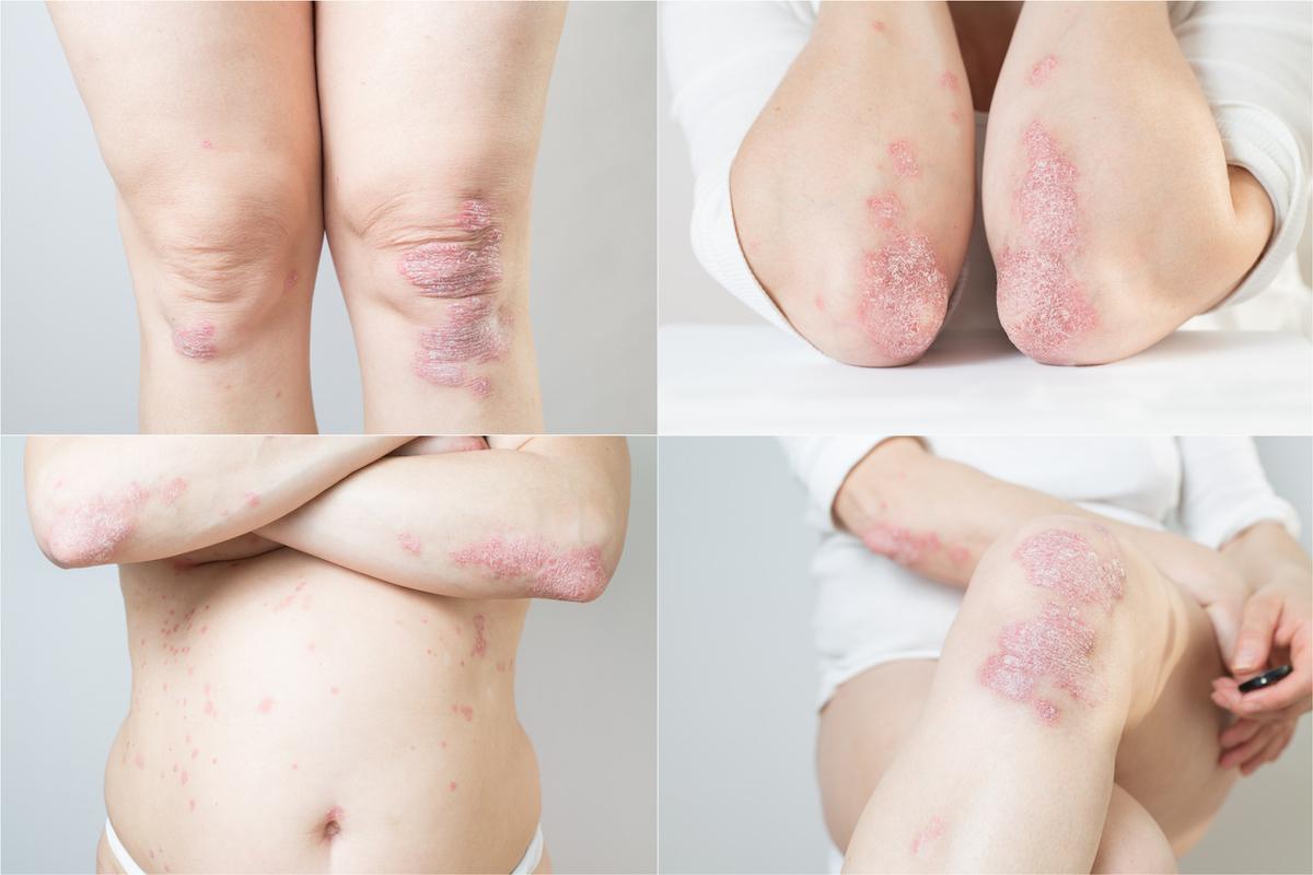 Rhumatisme psoriasique sévère : traiter tôt et fort en cas de mauvais pronostic