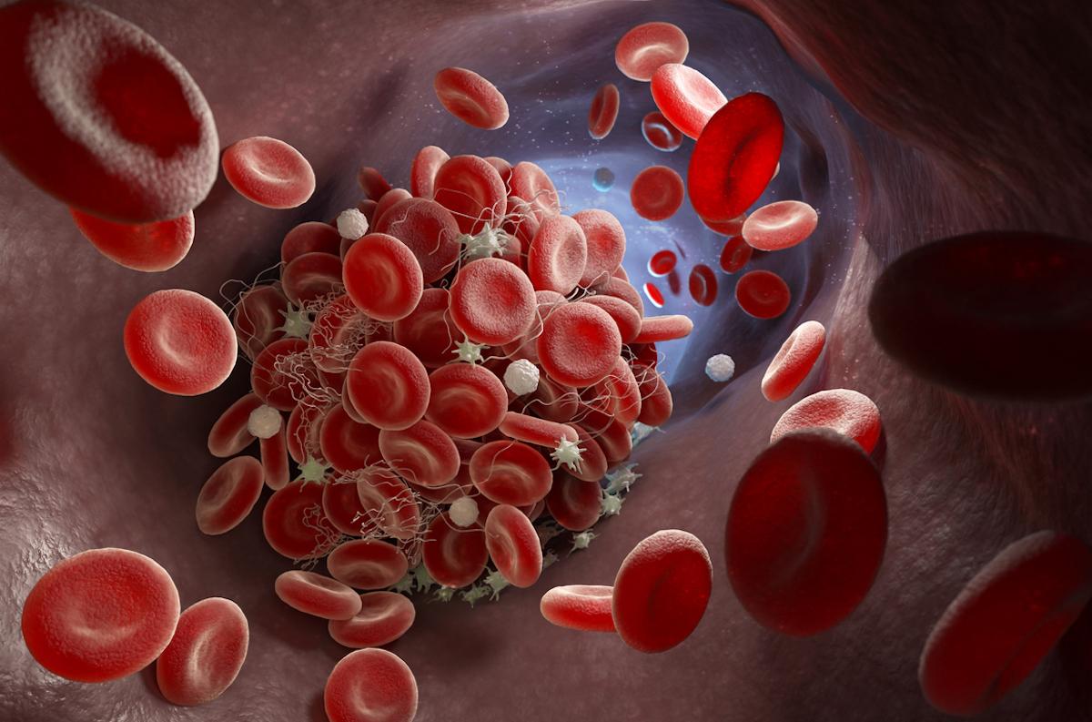 Cancer et thrombose : prolonger l’anticoagulation en prévention sans risque hémorragique