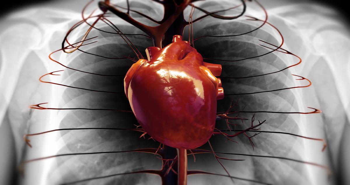 Amylose cardiaque à transthyrétine : le patisiran préserve la capacité fonctionnelle