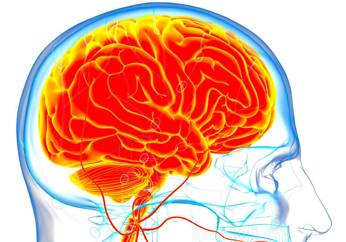 AVC vertébro-basilaires : bénéfice confirmé de la thrombectomie