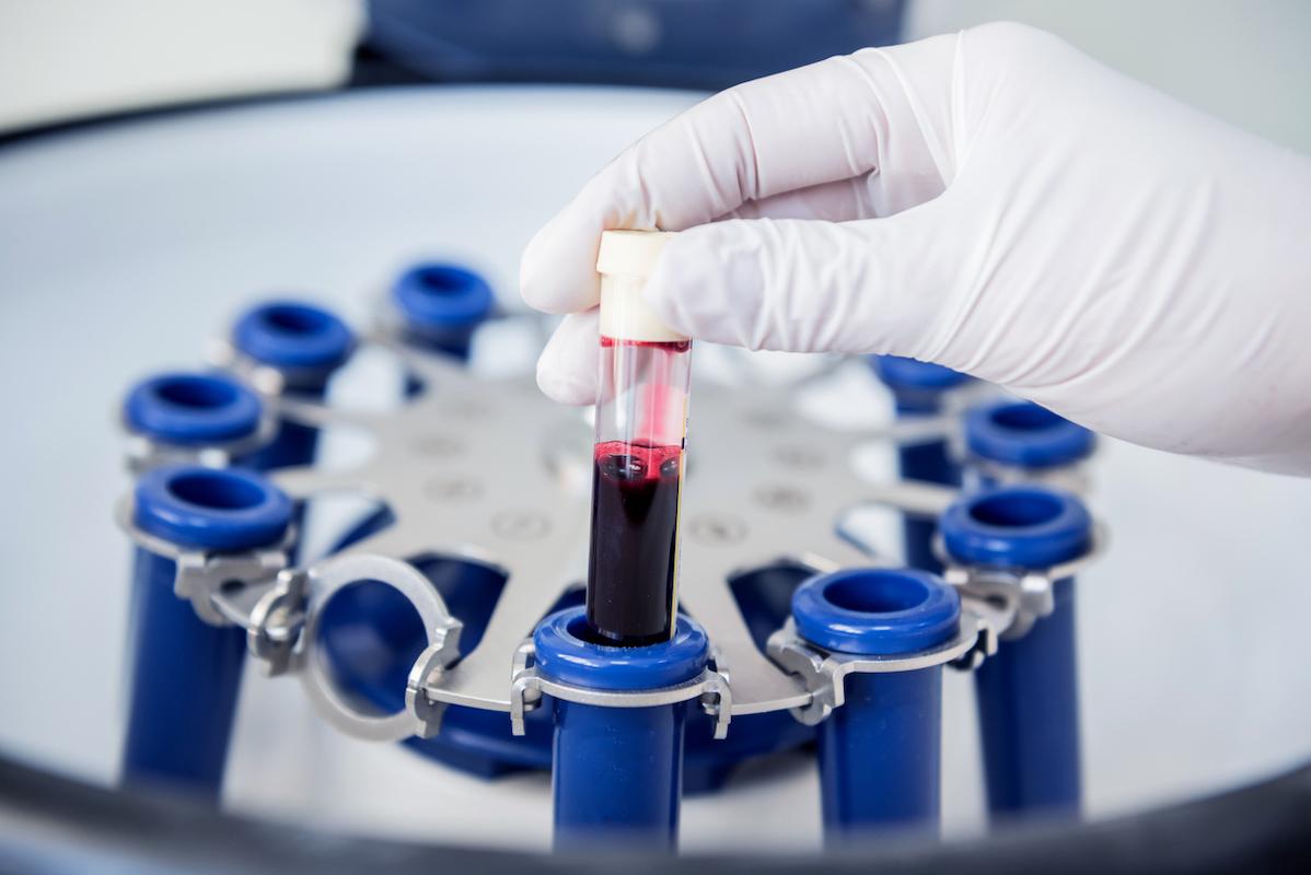 Cryoglobulinémies : désormais deux maladies distinctes