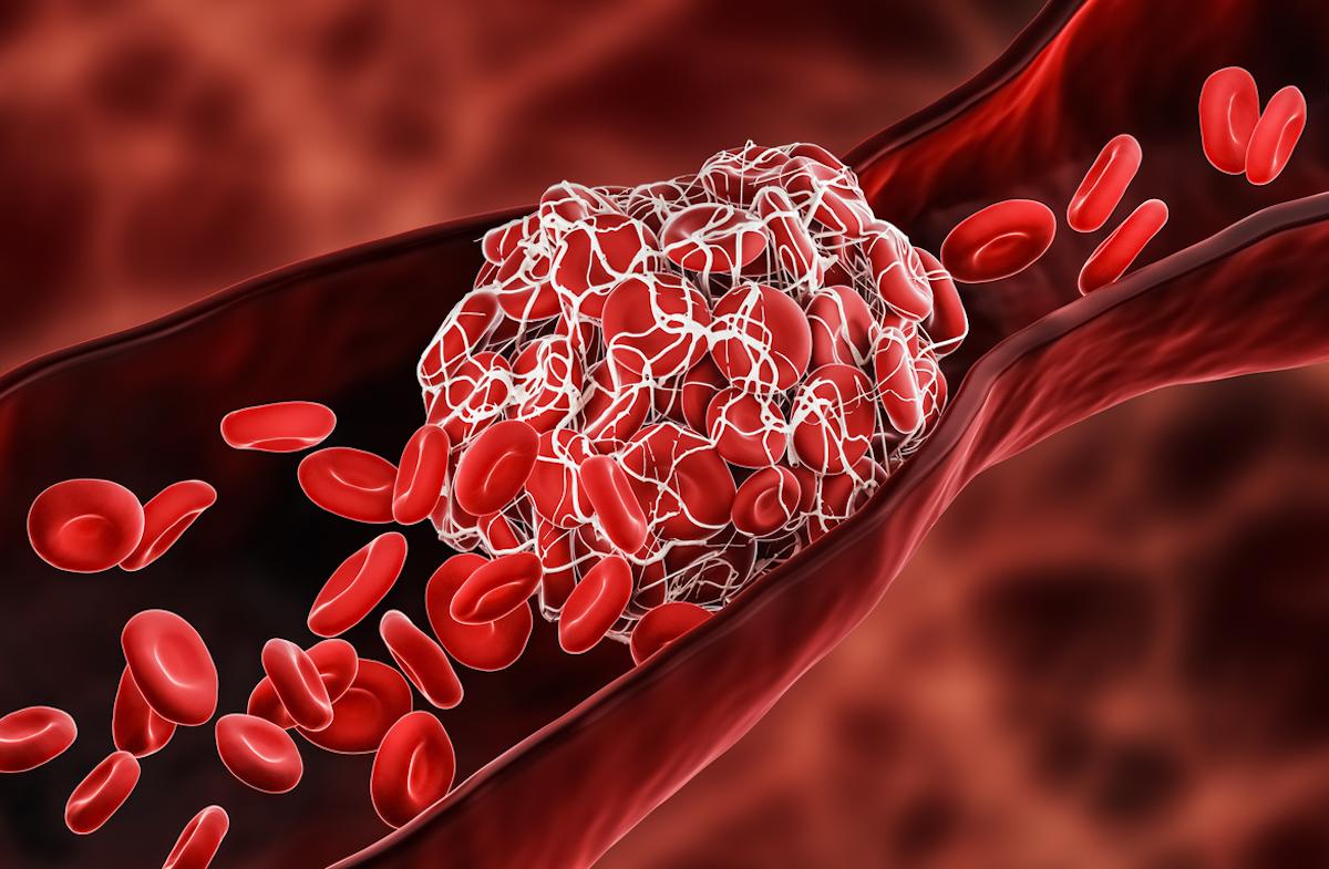 Cancers actifs : un AOD à doses réduite au long cours permet de prévenir les récidives thrombo-emboliques 
