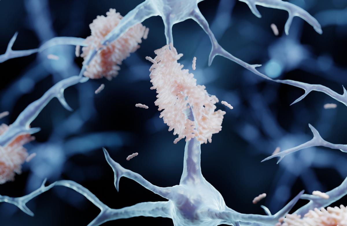 Maladie d'Alzheimer préclinique : résultats encourageants à 8 ans d’un anti-amyloïde 