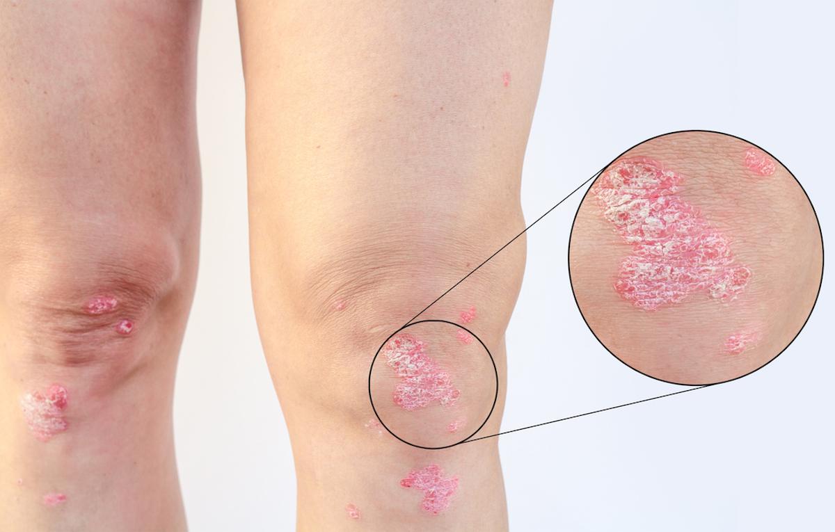 Psoriasis : risque de la transition vers le rhumatisme psoriasique précoce versus tardive