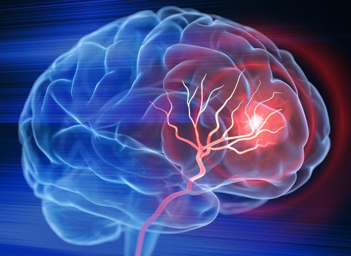 AVC : les nouvelles recommandations de prévention de l'American Stroke Association