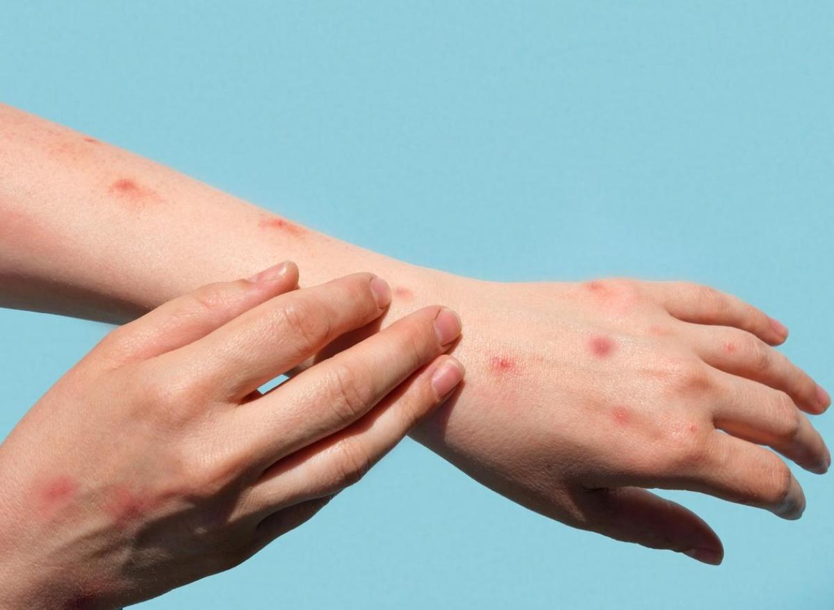 Mpox nouveau variant : un premier cas identifié en Allemagne 