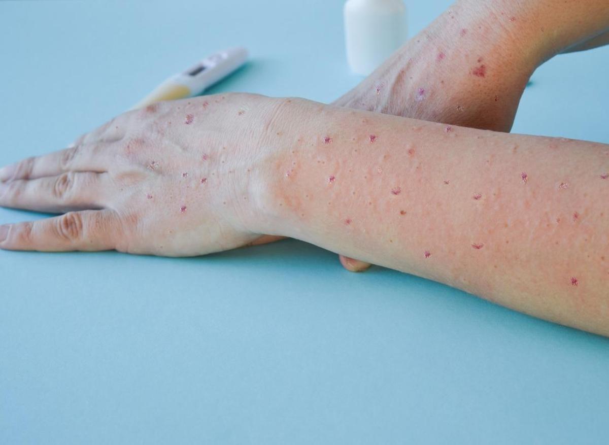 Mpox : un nouveau test diagnostique validé par l'OMS