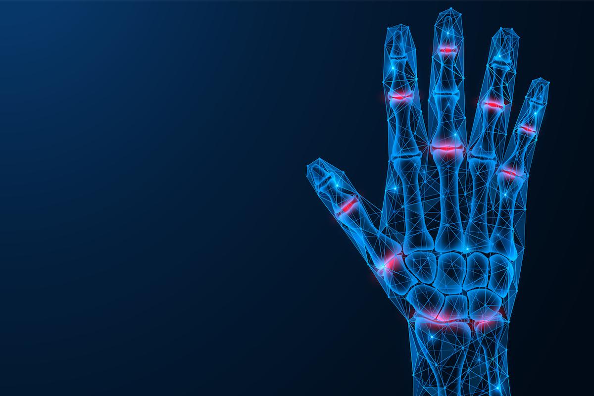Polyarthrite rhumatoïde et douleur : les JAKis seraient supérieurs aux biologiques 