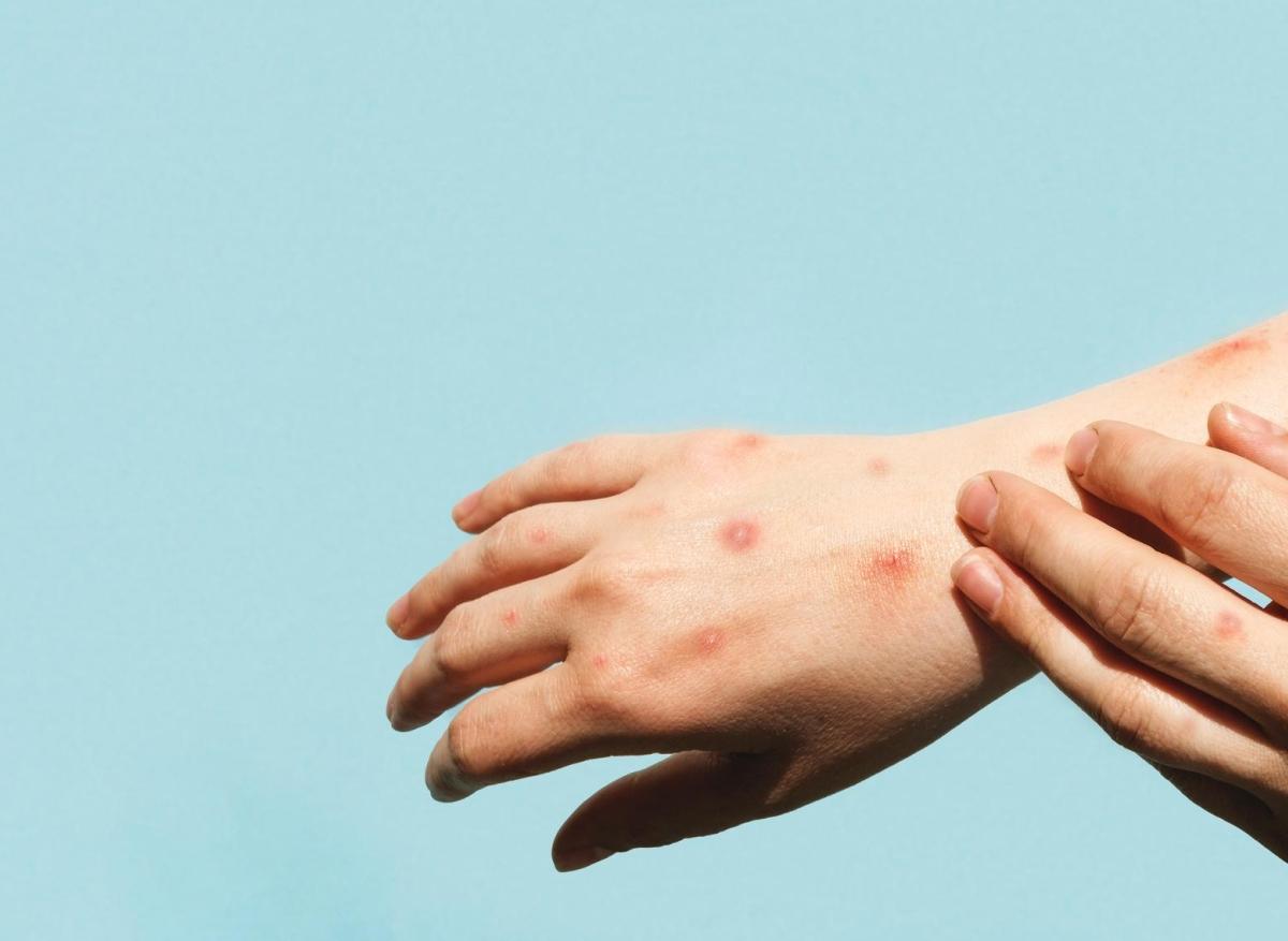 Vaccin MPox : on pourra le faire dans certaines pharmacies 