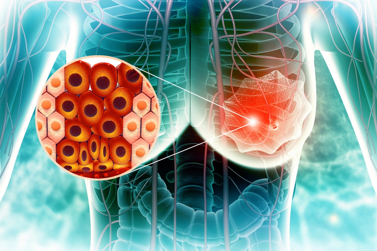 Cancer du sein : un nouvel pan-inhibiteur mTOR pour une trithérapie