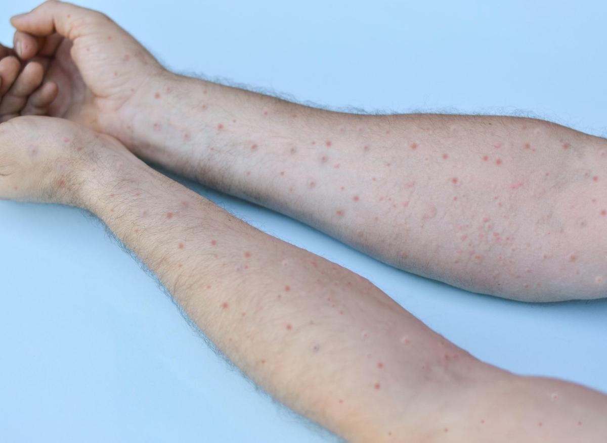 Mpox : un premier cas importé à l'île Maurice