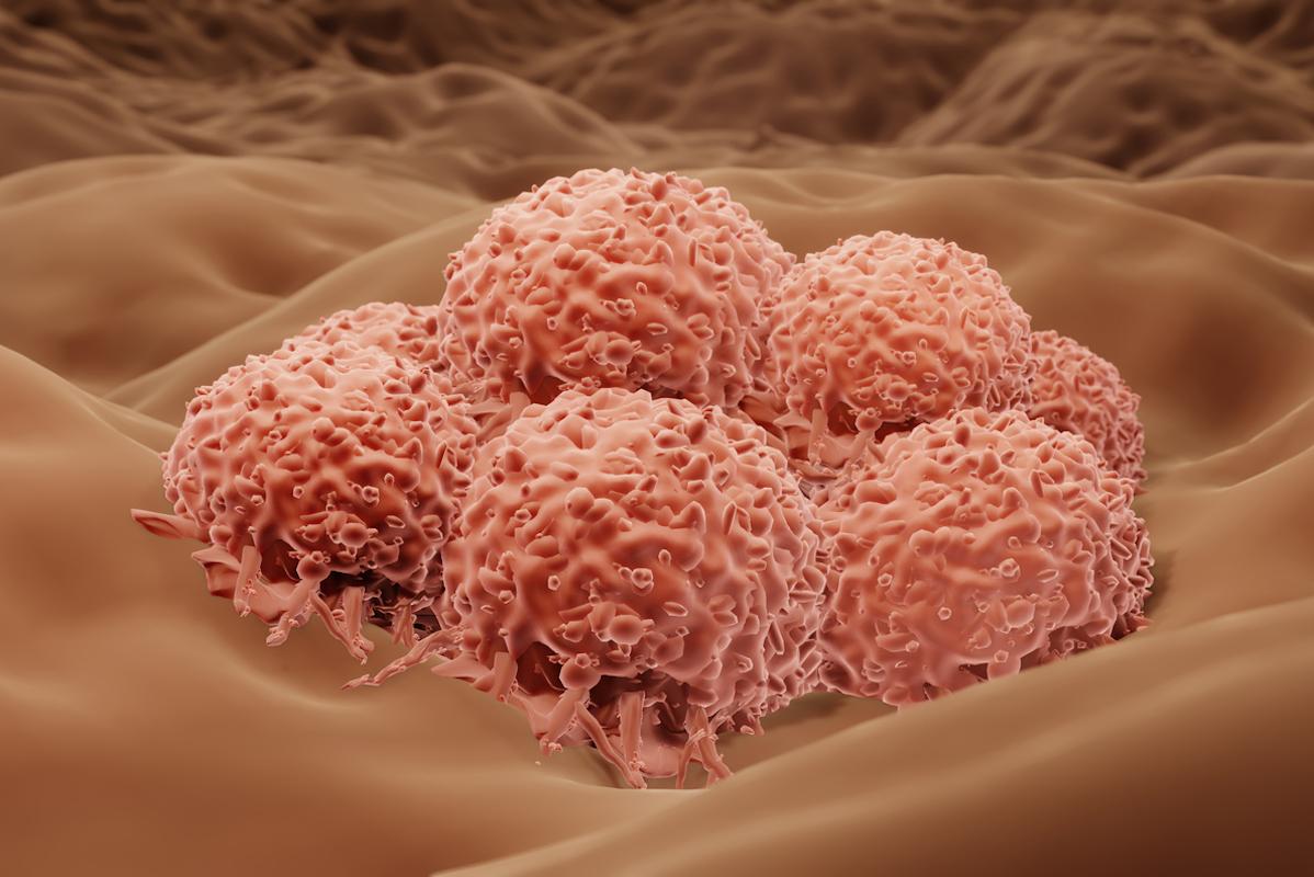 Mélanome stade III : nivolumab et ipilimumab en néoadjuvant améliorent la survie 
