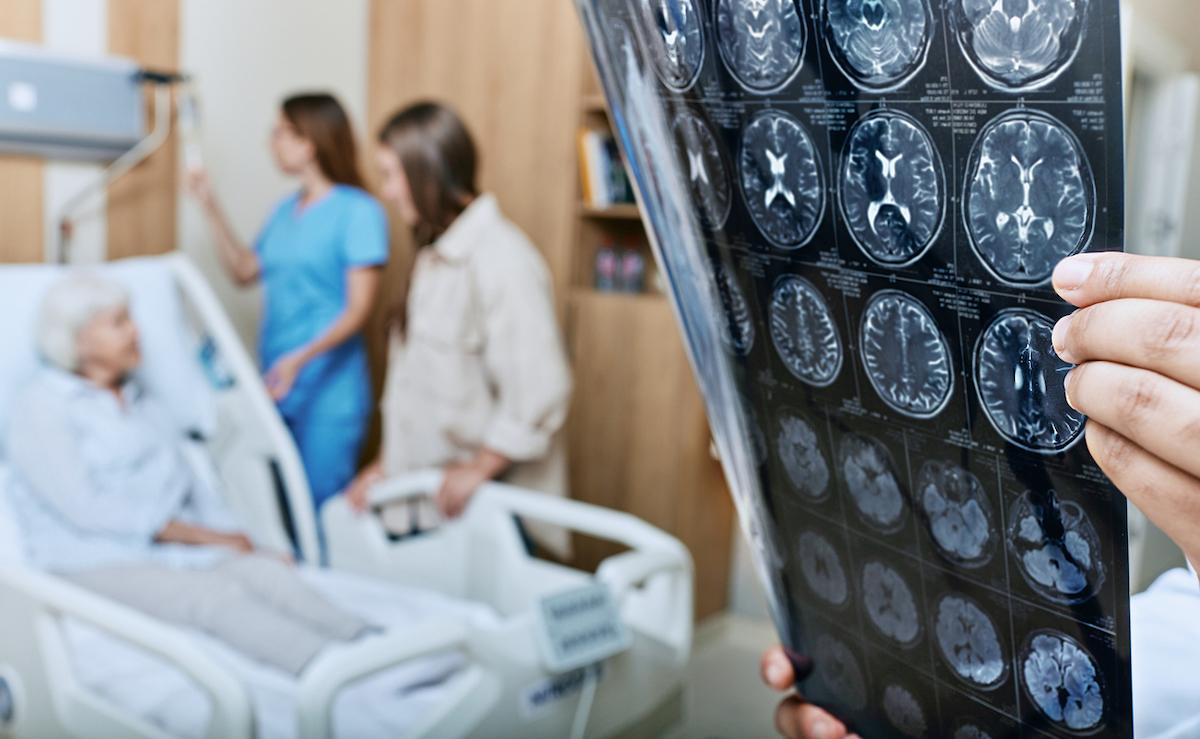 AVC avec infarctus étendu : résultats prometteurs de la thrombectomie 
