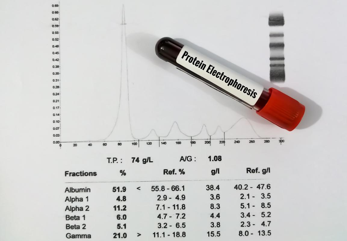 Gammapathie monoclonale (MGUS) : la prise de poids associée à la progression vers le myélome