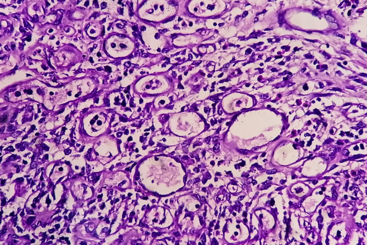 Adénocarcinome œso-gastrique avec maladie métastatique limitée : intérêt de la résection