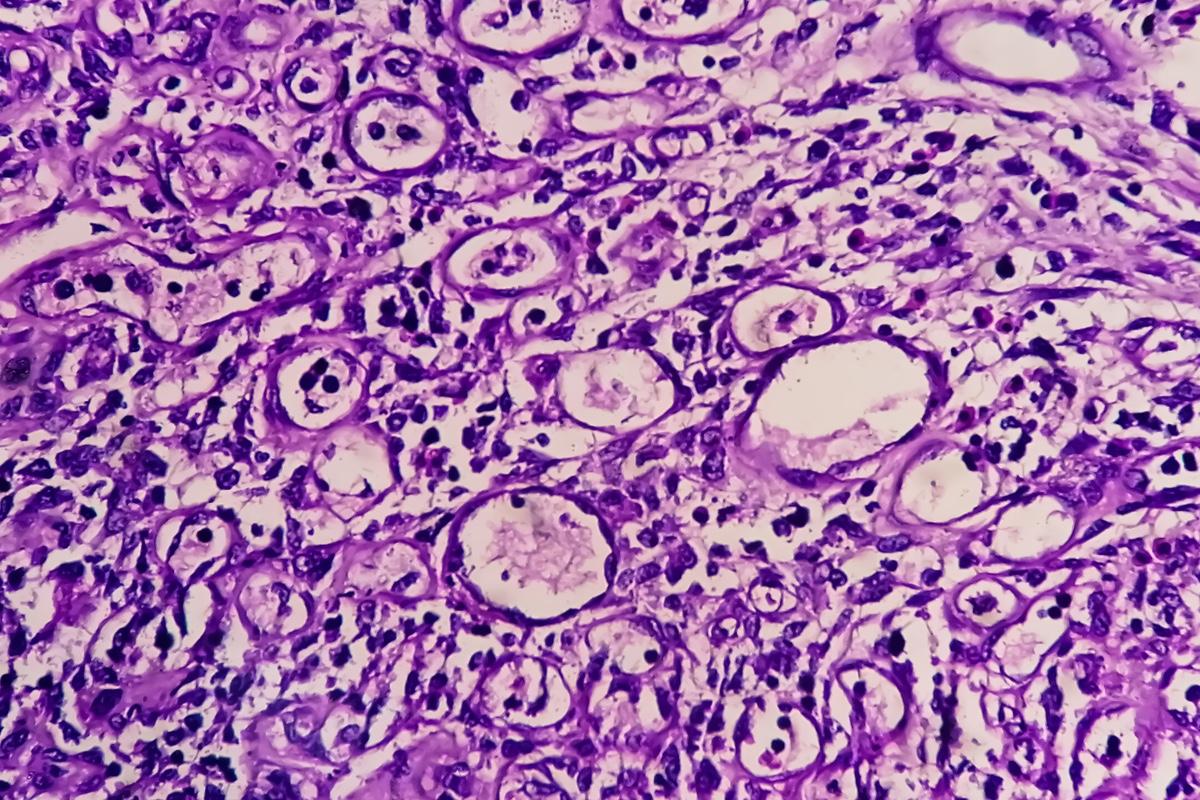  Adénocarcinome gastrique : une nouvelle stratégie de 2ème ligne contre la progression après immuno-chimiothérapie ?