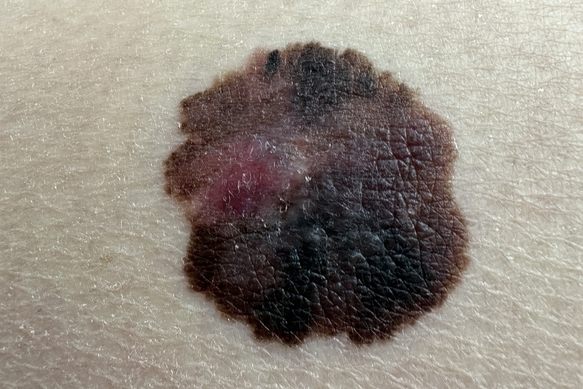 Mélanome de stade III :les bénéfices du pembrolizumab en adjuvant se maintiennent à long terme
