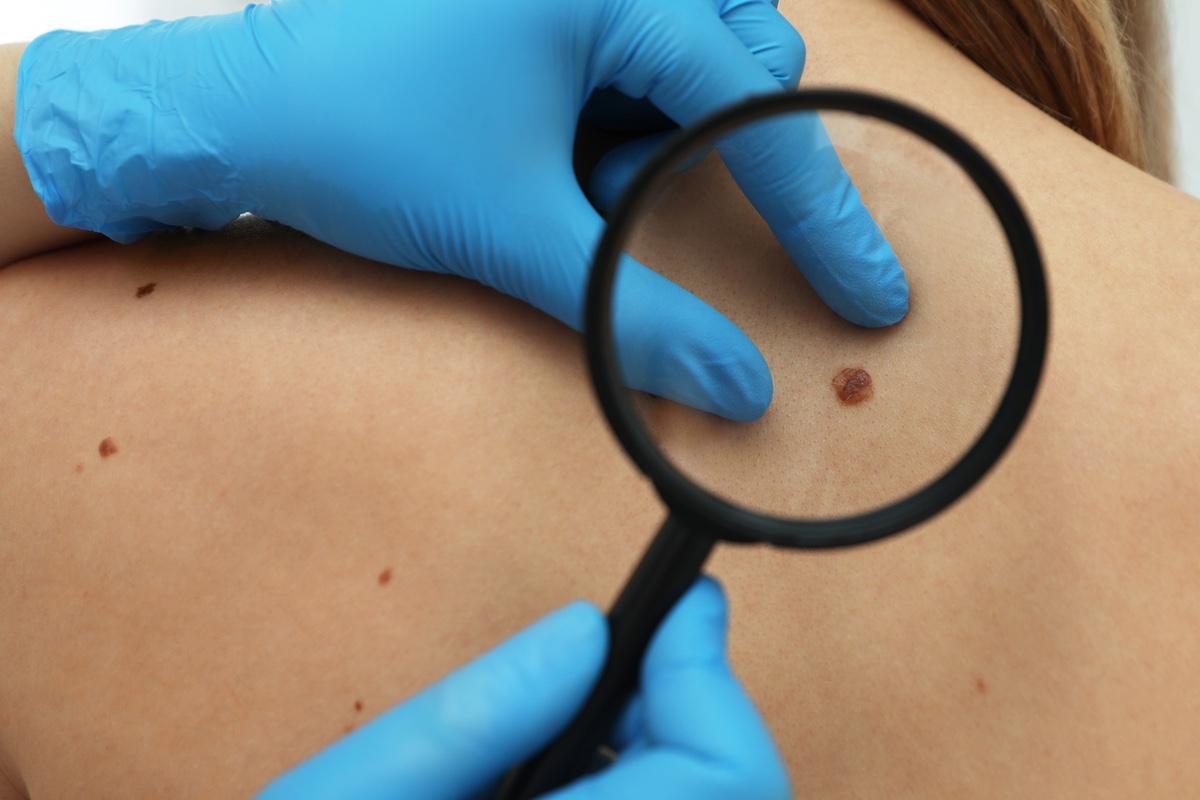 Mélanome in situ de petite taille : peu de récidive avec des marges de 5 mm 