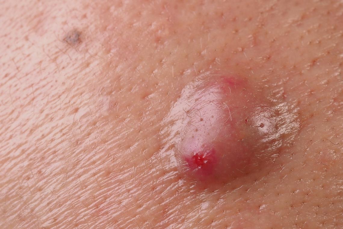 Carcinome de Merkel : les facteurs de risque mieux précisés 
