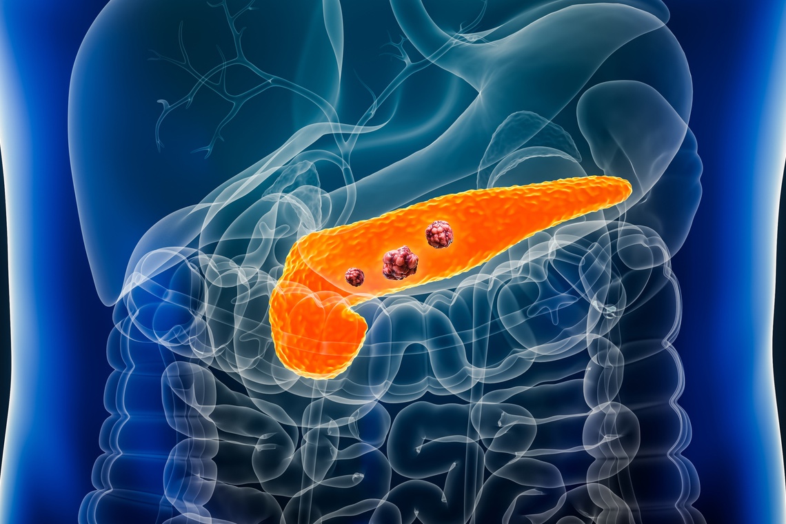Adénocarcinome du pancréas résécable : doit-on prendre en compte la latéralité ?