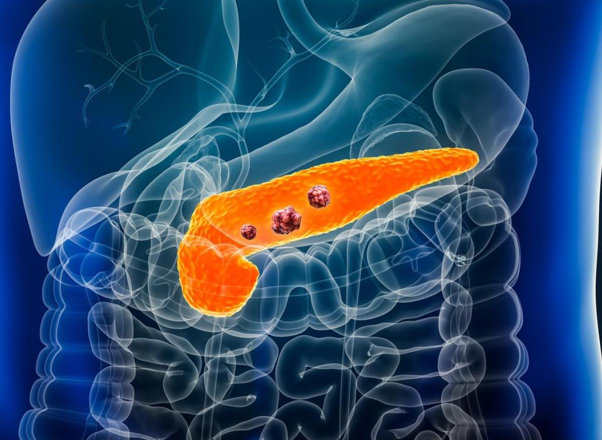 Cancer du pancréas : cibler la protéine Pin1 pour un traitement plus efficace