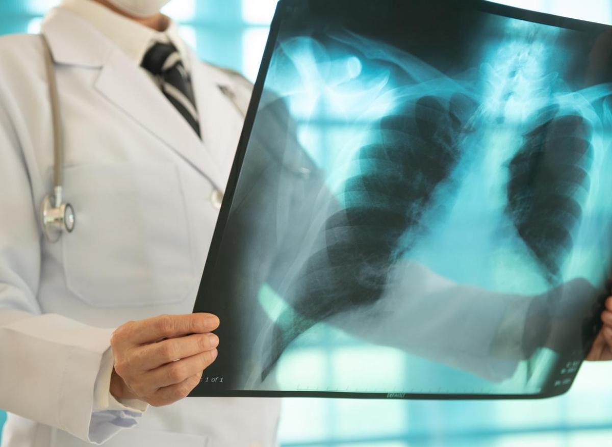 Cancer du poumon EGFR+ : le traitement ne fonctionne pas chez les patients p53