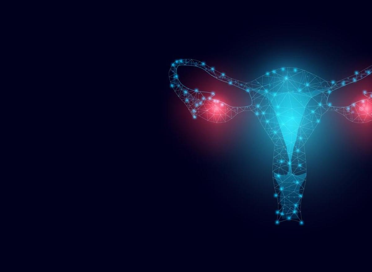 Endométriose : un risque de cancer de l’ovaire 4 fois  plus important