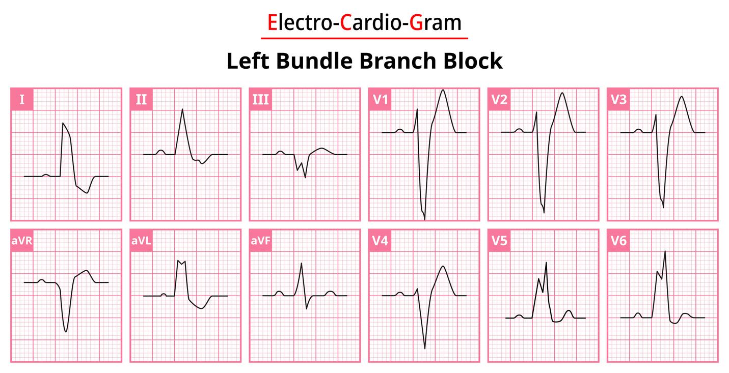 Insuffisance cardiaque et bloc de branche : quelle stimulation ?