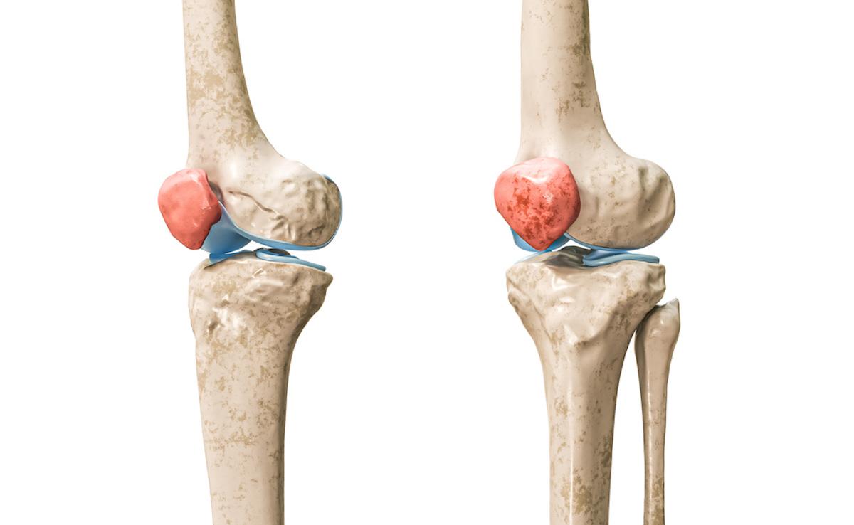 Instabilité du genou : quand évoquer une Patella alta et quelle attitude adopter ?