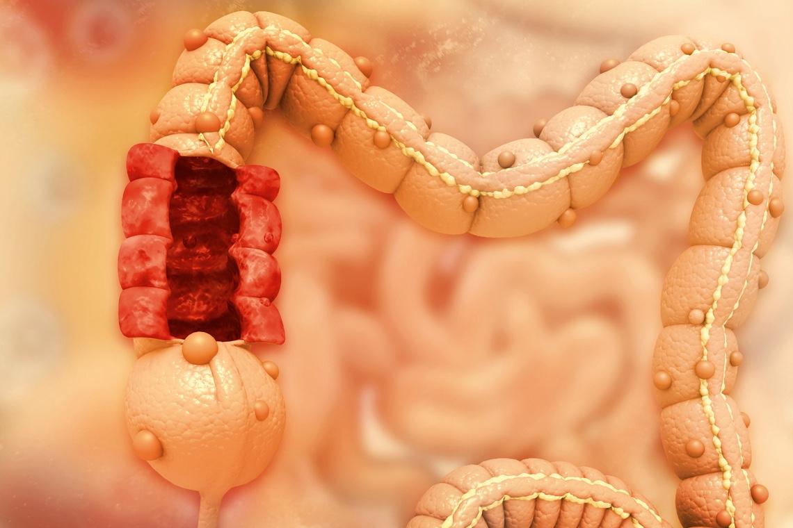 Cancer colorectal localisé : l’aspirine peut-elle guérir les patients ?