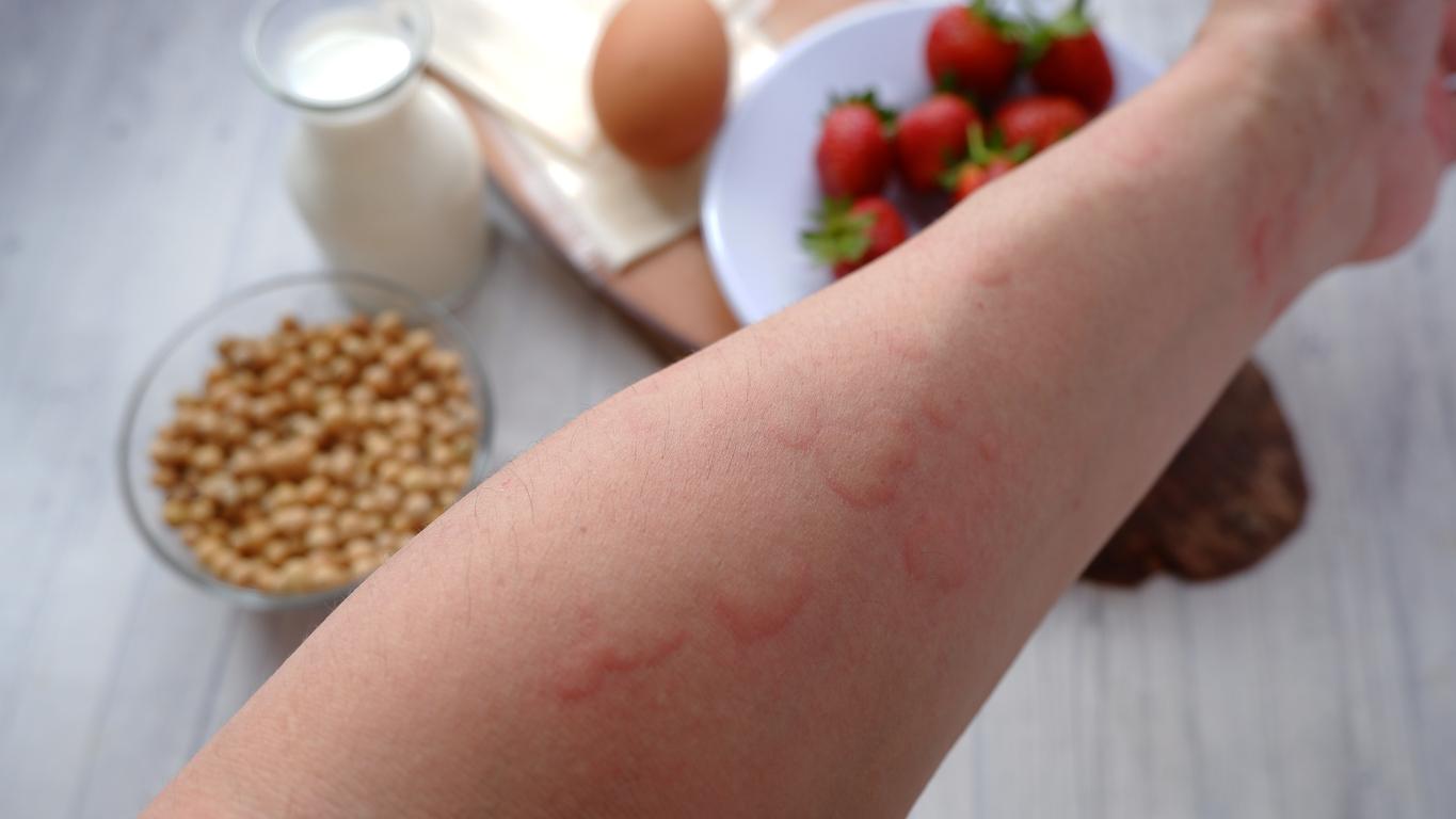 Allergies alimentaires : rôle préventif des cellules dendritiques RORγt+ dans l'intestin
