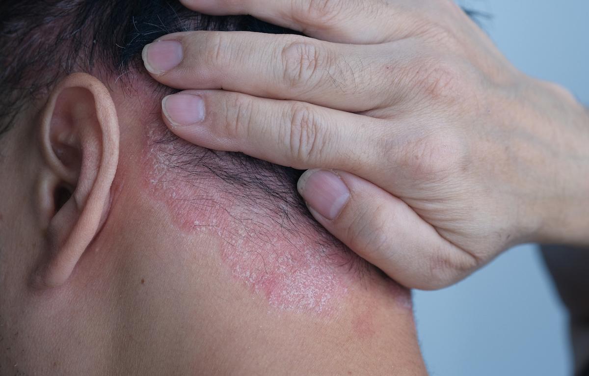 Rhumatisme psoriasique : un inhibiteur de Tyk-2 améliore les atteintes cutanéo-articulaires et la qualité de vie