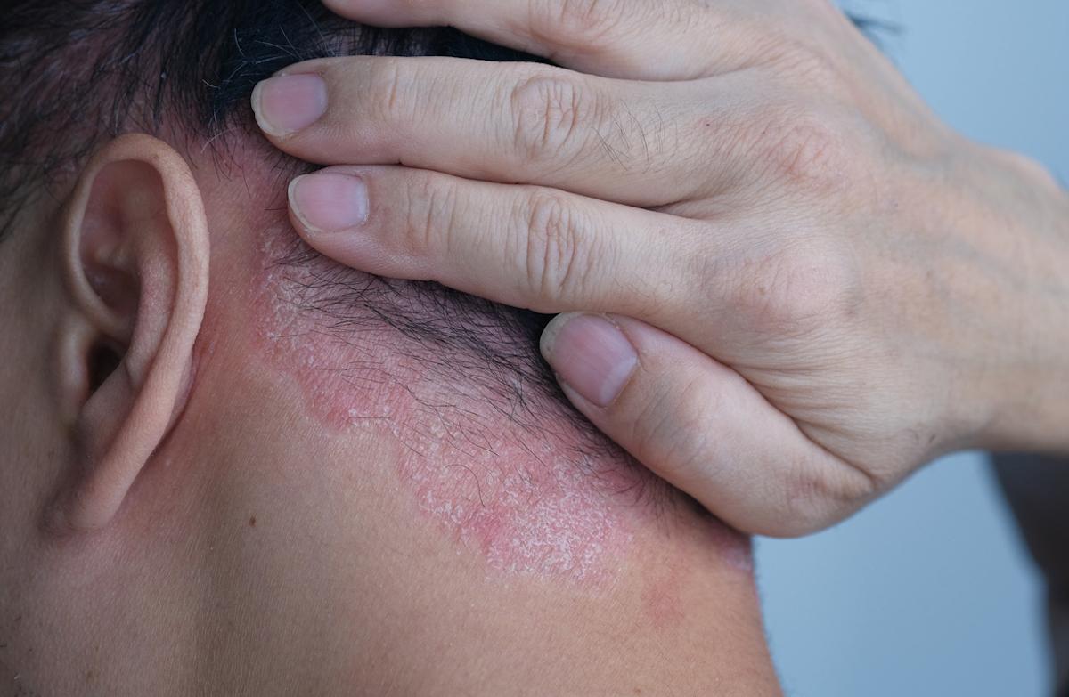 Psoriasis cutané : pas de bénéfice évident à associer méthotrexate et adalimumab 