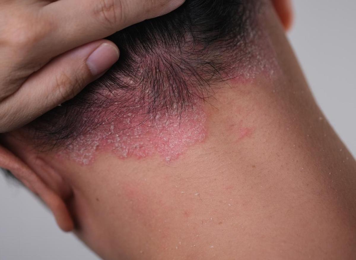 Psoriasis : une nouvelle cible de traitement