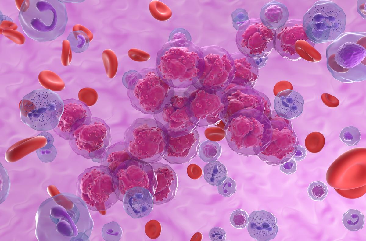 Leucémie aiguë lymphoblastique Ph+ : intérêt de la poursuite du ponatinib jusquà MRD négative