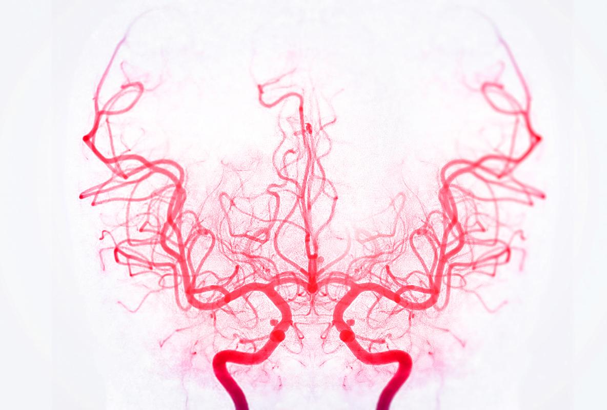 AVC ischémique : intérêt de la thrombolyse adjuvante après thrombectomie ?