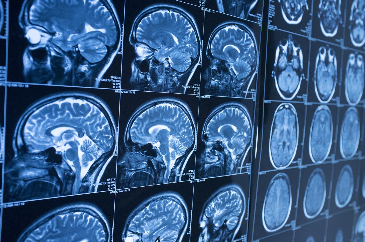 Parkinson : un nouvel espoir fondé sur l’immunothérapie