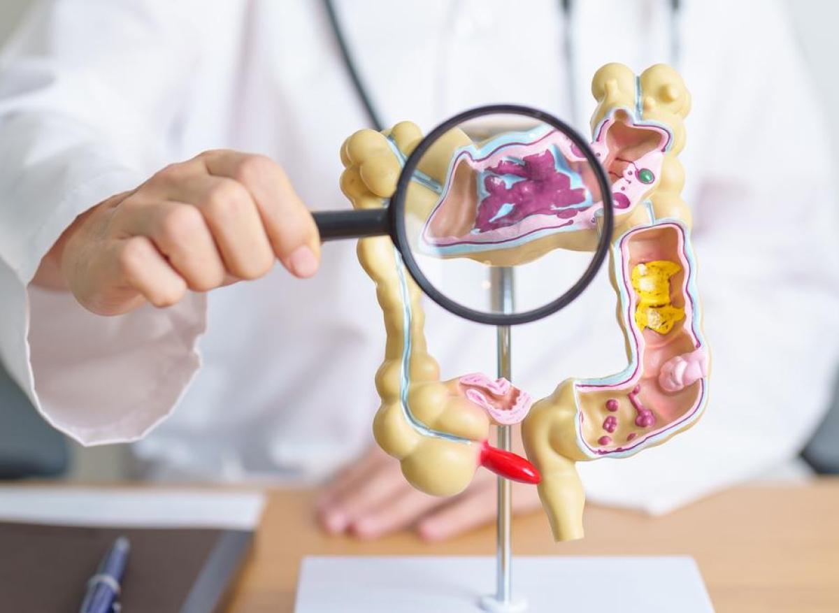 Cancer colorectal : le stress chronique joue sur le microbiote et accélère sa propagation
